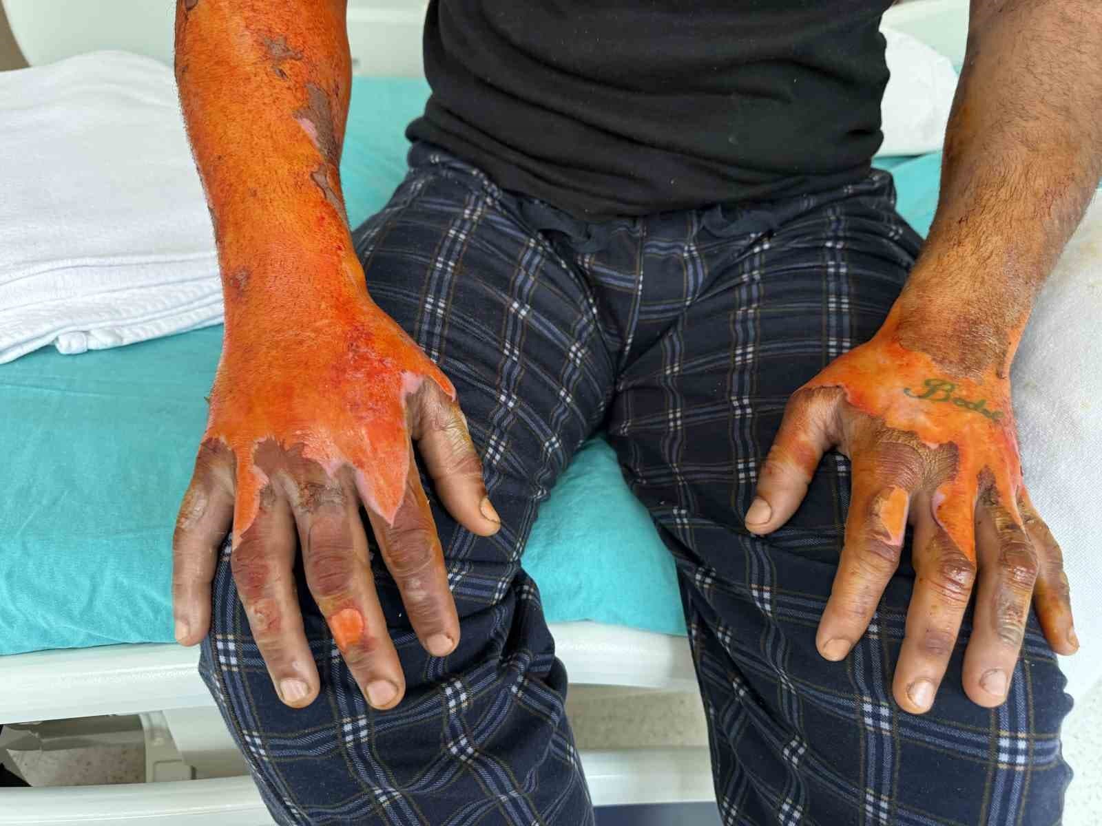 Araç Aküsü Patlaması Dehşeti: Vücudunun Yüzde 25'i Yandı